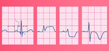 Evidence based Management of STEMI